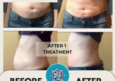 Abdomen before and after