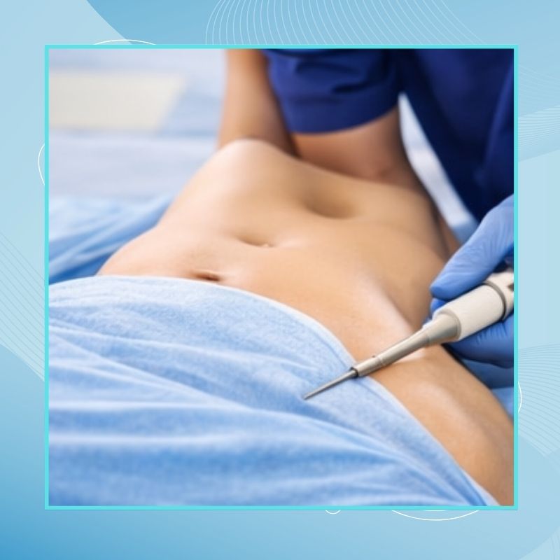 Liposuction
