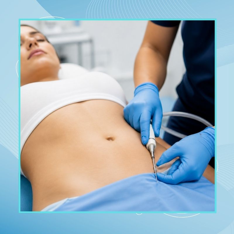 Liposuction